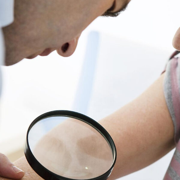 Skin Cancer Treatment